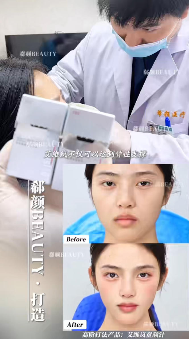 上海艾维岚童颜针_陈达抗衰拒绝假面案例